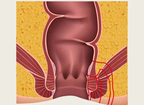 Anal Fistula consultation at Niraaya Hospital